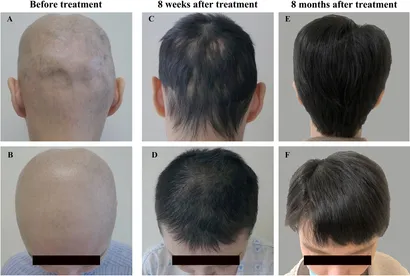 Style Alopecia GR+ サプリメント 30g Amazon.com : Alopecia Amazing Hair Growth : Hair Growth