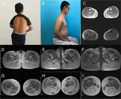 Muscle Diseases (神経学) Muscular Swedish mutant APP-to-Brain axis in the development