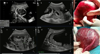 Extra Uterine Pregnancy | Disastrous Murmur