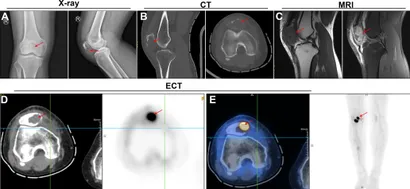 Frontiers | Evaluating Heterogeneity of Primary Lung Tumor