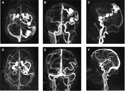 Frontiers | Spontaneous regression of multiple flow-related Frontiers | Spontaneous regression of multiple flow-related