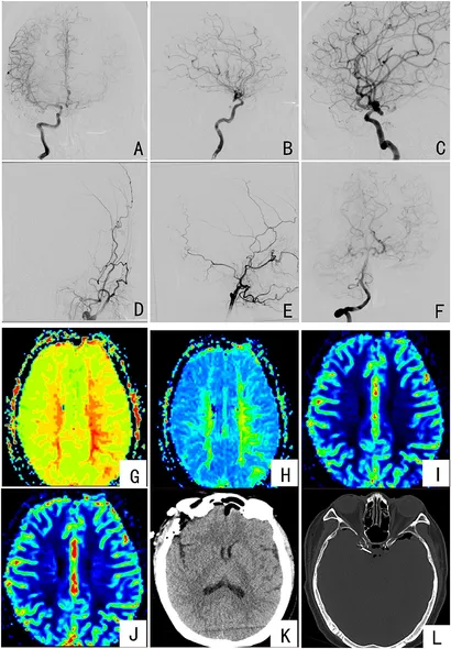 Aneurysms and Arteriovenous Anomalies of the Brain ハード