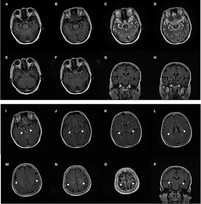 Frontiers | ANXA11 mutations are associated with amyotrophic Frontiers | ANXA11 mutations are associated with amyotrophic