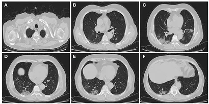 健康・医学 high-resolution CT of the lung Image Quality from High-Resolution CT of the Lung
