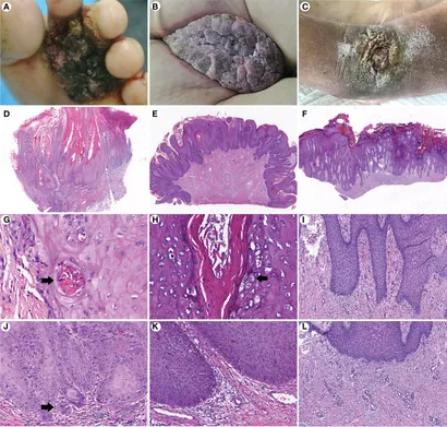 Viscera Infest – Verrucous Carcinoma（帯付） HQRLP - 011 Viscera Infest – Verrucous Carcinoma | Huangquan