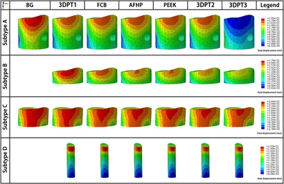 Multiplanar correction of proximal tibial recurvatum