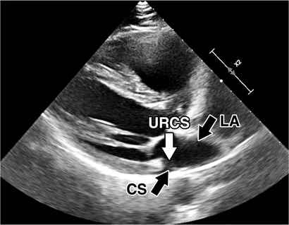 アンナ Frontiers | Case report: Robotic repair of unroofed coronary
