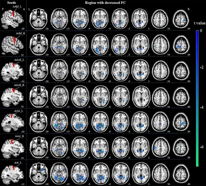 BRAIN AND NERVE2021年11月号 Investigating sex-related differences in brain structure and