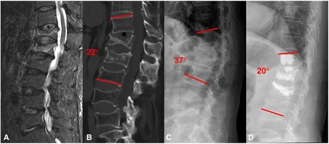 Simultaneous targeting of PI3Kδ and a PI3Kδ-dependent MEK1/2