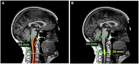 Multicentre, double-blind, randomised, sham-controlled trial