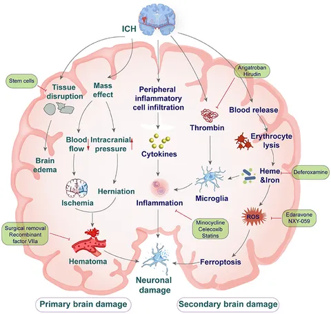 New Insights in Intracerebral Hemorrhage (Frontiers of Neurology and Neuroscience) [ハードカバー] Toyoda， Kazunori? Anderson， Craig S.; Mayer， Stephan A. fneur-13-1032343-g001.jpg