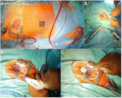 Minimally Invasive Cardiac Surgery: A Practical Guide