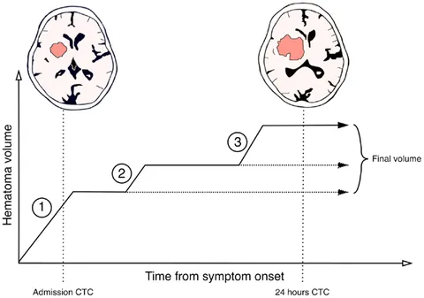 New Insights in Intracerebral Hemorrhage (Frontiers of Neurology and Neuroscience) [ハードカバー] Toyoda， Kazunori? Anderson， Craig S.; Mayer， Stephan A. Amazon.com: New Insights in Intracerebral Hemorrhage