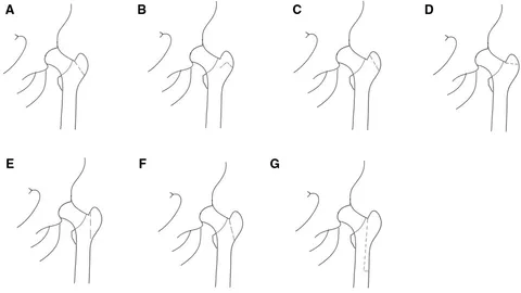 大腿骨近位部骨折 Osteosynthesis & Arthroplasty Osteosynthesis, hemiarthroplasty, total hip arthroplasty in