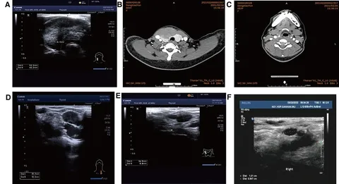 Thyroid Cancer Explore vol.1 no.2(2015 「Thyroid Cancer Expl Next-Generation Molecular Imaging of Thyroid Cancer