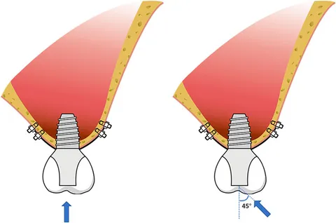 Frontiers | Biomechanical evaluation of custom-made short