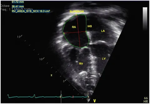 Echocardiography in Pediatric and Adult Congenital Heart