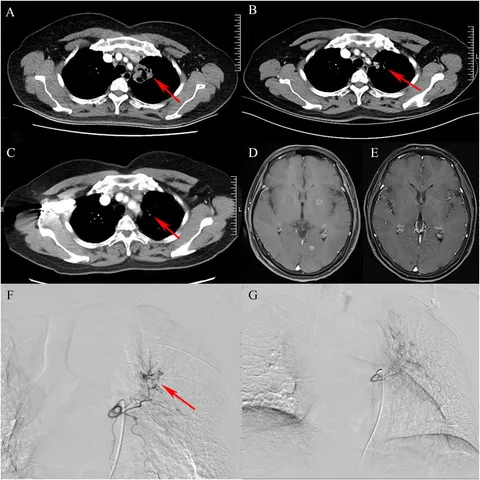 ℳ. Frontiers | Role of gasdermins in chronic kidney disease