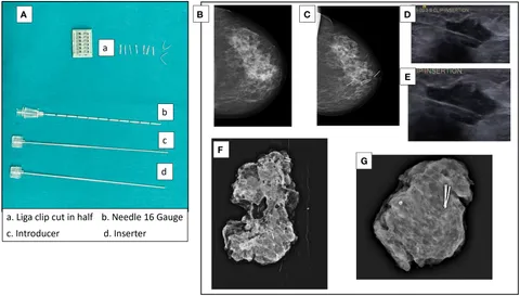 健康・医学 Preneoplasia of the Breast Breast Cancer Treatment (PDQ®): Treatment - Patient