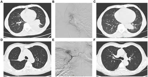 テストテスト Bronchial artery chemoembolization with drug-eluting beads