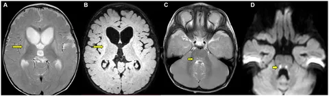 A Novel KIDINS220 Pathogenic Variant Associated with the