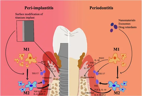 Zero Peri-implantitis Concept インプラント周囲炎 インプラント周囲炎ゼロコンセプト