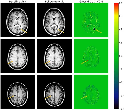 Genetic variants linked to ADHD and Parkinson's, Queensland