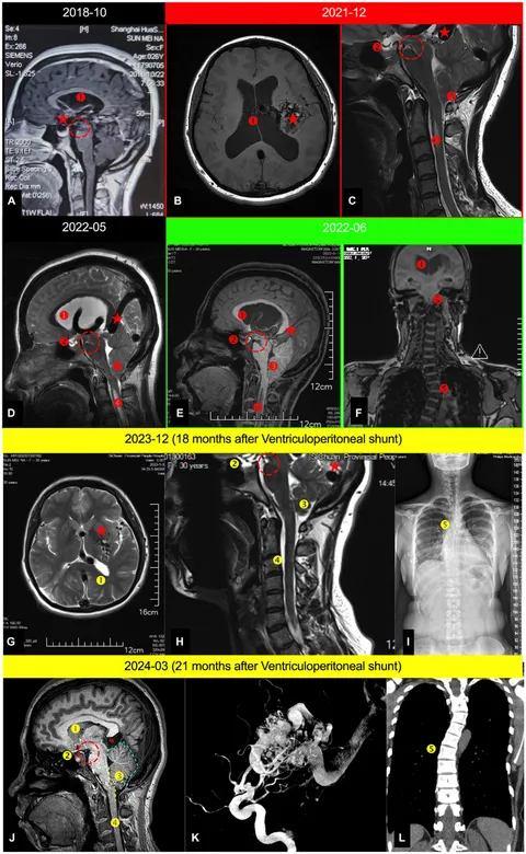 Aneurysms and Arteriovenous Anomalies of the Brain ハード