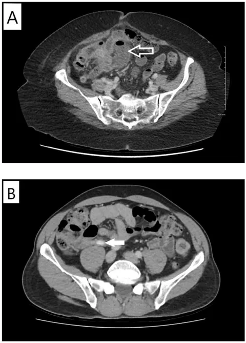 内科診断学 = MEDICAL DIAGNOSIS Preclinical Evaluation and Pilot Clinical Study of CD137 PET