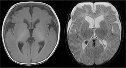 Case 18-2024: A 64-Year-Old Woman with the Worst Headache of