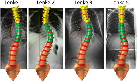 脊椎脊髄病学 = PRINCIPLES OF SPINAL DISORDERS Spinal Disorders: Fundamentals of Diagnosis and Treatment