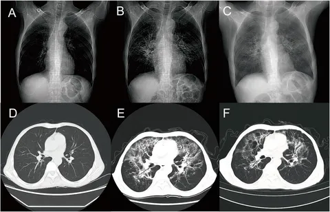 Frontiers | A case report: interstitial pneumonia following