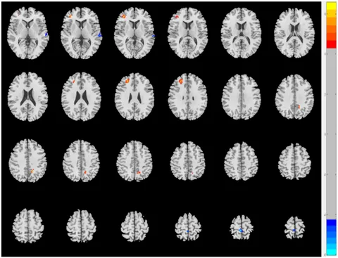 Frontiers | Pain- and depression-related regional homogeneity