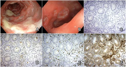 Frontiers | Ocrelizumab-induced colitis—critical review and