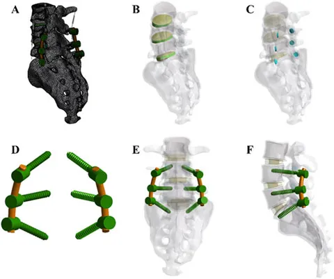 Frontiers | Biomechanical effects of screw loosening after