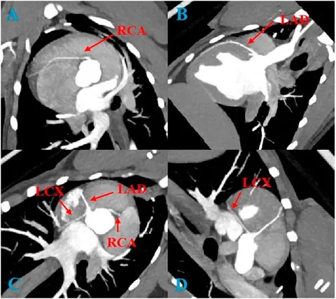 Frontiers | Impact of Cordyceps sinensis on coronary
