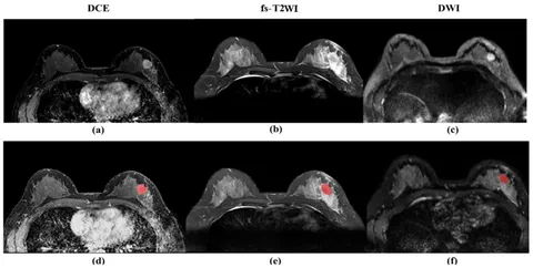 Frontiers | Developing a predictive model for neoadjuvant