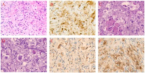 Frontiers | Case report: Primary subcutaneous Rosai-Dorfman