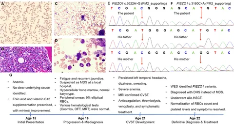 Frontiers | Novel compound heterozygous PIEZO1 variants in