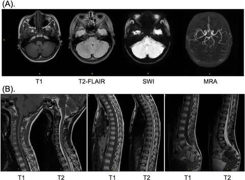 Frontiers | The utilization of efgartigimod in the treatment