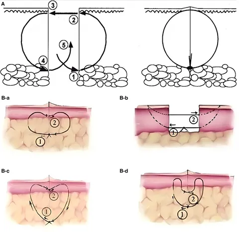 Frontiers | Progress in tension-relieving suturing surgery