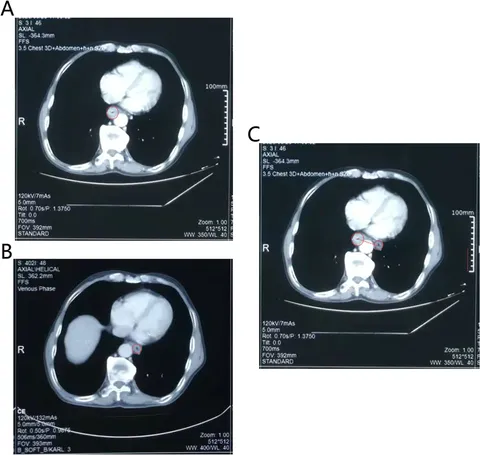 Frontiers | Case Report: The huge esophageal displacement: a