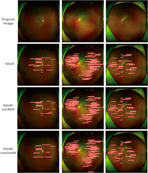 Frontiers | Automated detection of diabetic retinopathy