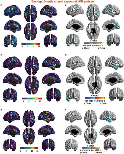 Frontiers | The Alterations of Cortical Volume, Thickness