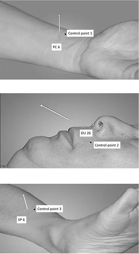 Closed IV Catheter Nexiva™ 24 Gauge 3/4 Inch - McKesson