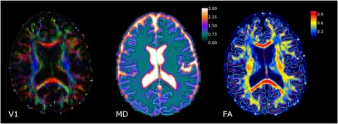 Brain, Fibre Tractography Image - Album alb3786280