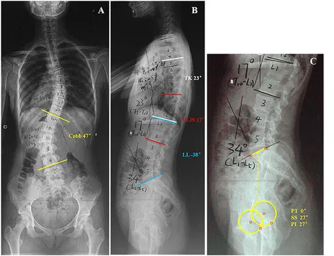 Frontiers | PI and T9-SPI: New Predictive Factors for