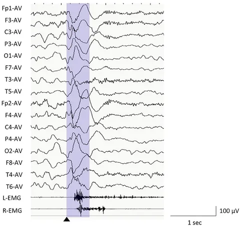 eeg 2011年 Subcortical electrophysiological activity is detectable with