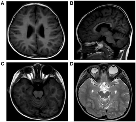 【裁断済】Common Diseases Up to date Altered white matter microstructure in 22q11.2 deletion