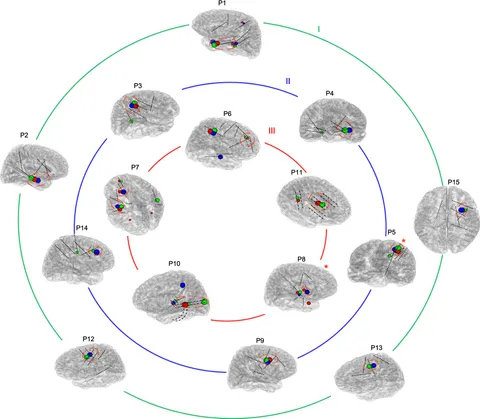 ティム Frontiers | Localization of the Epileptogenic Zone by